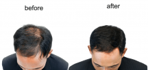 Kaliteli Protez Saç Nasıl Anlaşılır?